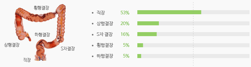 발생부위별 발병률 - 직장:52.6%, 상행결장:19.5%, S자 결장:16.1%, 횡행결장: 5.2%, 하행결장: 4.6%